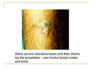 Starts as one ulcerative lesion and then chains
Up the lymphatics – can involve lymph nodes
and bone
 
