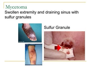 Swollen extremity and draining sinus with
sulfur granules
Sulfur Granule
Mycetoma
 