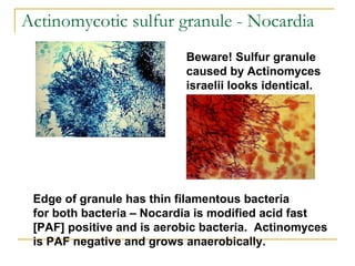Edge of granule has thin filamentous bacteria
for both bacteria – Nocardia is modified acid fast
[PAF] positive and is aerobic bacteria. Actinomyces
is PAF negative and grows anaerobically.
Beware! Sulfur granule
caused by Actinomyces
israelii looks identical.
Actinomycotic sulfur granule - Nocardia
 