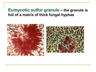 Eumycotic sulfur granule – the granule is
full of a matrix of thick fungal hyphae
 