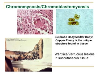 Chromomycosis/Chromoblastomycosis
Wart like/Verrucous lesions
In subcutaneous tissue
Sclerotic Body/Medlar Body/
Copper Penny is the unique
structure found in tissue
 