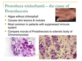 Prototheca wickerhamii – the cause of
Protothecosis
 Algae without chlorophyll
 Causes skin lesions & nodules
 Most common in patients with suppressed immune
system
 Compare morula of Protothecosis to sclerotic body of
Chromomycoses
 