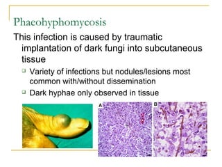 Phaeohyphomycosis
This infection is caused by traumatic
implantation of dark fungi into subcutaneous
tissue
 Variety of infections but nodules/lesions most
common with/without dissemination
 Dark hyphae only observed in tissue
 