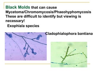 Exophiala species
Black Molds that can cause
Mycetoma/Chromomycosis/Phaeohyphomycosis
These are difficult to identify but viewing is
necessary!
Cladophialophora bantiana
 