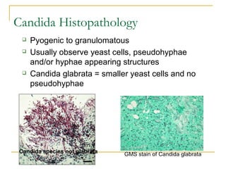 Candida Histopathology
 Pyogenic to granulomatous
 Usually observe yeast cells, pseudohyphae
and/or hyphae appearing structures
 Candida glabrata = smaller yeast cells and no
pseudohyphae
GMS stain of Candida glabrataCandida species not glabrata
 