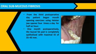 ORAL SUBMUCOUS FIBROSIS (OSMF) | PPTX