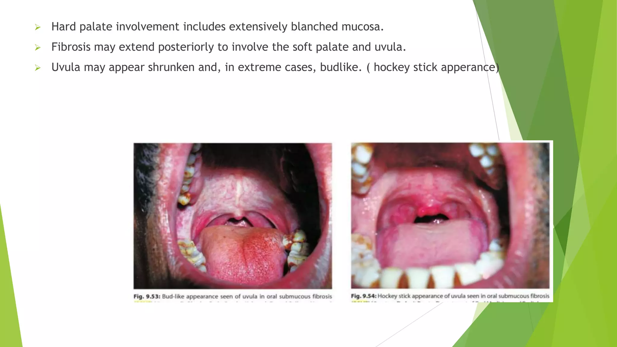 oral submucous fibrosis | PPTX