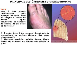 PRINCIPAIS DISTÚRBIO SIST URINÁRIO HUMANO
GOTA
Gota
é
uma
doença
caracterizada
pela
elevação de ácido úrico
no sangue e surtos de
artrite
aguda
secundários ao depósito
de cristais do sal deste
ácido (uratos).

 O ácido úrico é um resíduo nitrogenado do
metabolismo de purinas (lembrar das bases
nitrogenadas).
 Mariscos, sardinha, salmão, bacon, fígado
devem ser evitados por aqueles que sofrem de
gota.

 