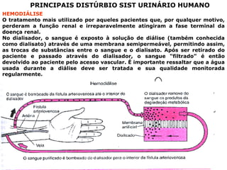 PRINCIPAIS DISTÚRBIO SIST URINÁRIO HUMANO
HEMODIÁLISE
O tratamento mais utilizado por aqueles pacientes que, por qualquer motivo,
perderam a função renal e irreparavelmente atingiram a fase terminal da
doença renal.
No dialisador, o sangue é exposto à solução de diálise (também conhecida
como dialisato) através de uma membrana semipermeável, permitindo assim,
as trocas de substâncias entre o sangue e o dialisato. Após ser retirado do
paciente e passado através do dialisador, o sangue “filtrado” é então
devolvido ao paciente pelo acesso vascular. É importante ressaltar que a água
usada durante a diálise deve ser tratada e sua qualidade monitorada
regularmente.

 