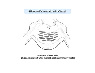 Why specific areas of brain affected

Sketch of Human Pons
close admixture of white matter bundles within gray matter

 