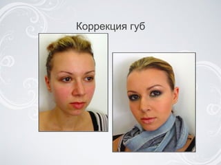 Коррекция губ 