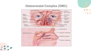Omc Complex ppt rhinitis alergi pada pasien dan kasusnya | PPTX