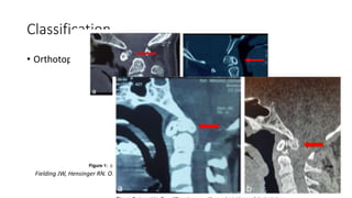 os-odontoideum-pptx
