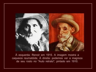 À esquerda: Renoir em 1915. A imagem mostra a
caquexia reumatóide. À direita: podemos ver a magreza
   de seu rosto no "Auto retrato", pintado em 1910.
 