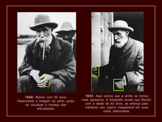 1896- .Renoir com 55 anos
, -Observando a imagem de perto pode
se visualizar o inchaço das
.articulações
1903- Aqui vemos que a artrite se tornou
. ,mais agressiva A fotografia revela que Renoir
,com a idade de 62 anos se esforça para
mantener seu cigarro inseparável em suas
.mãos deformadas
 