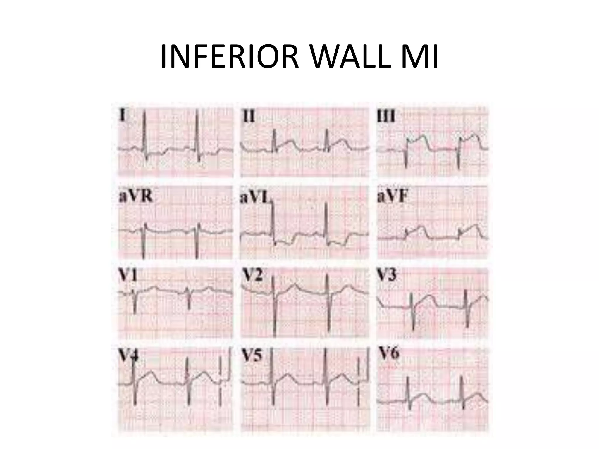 INFERIOR WALL MI