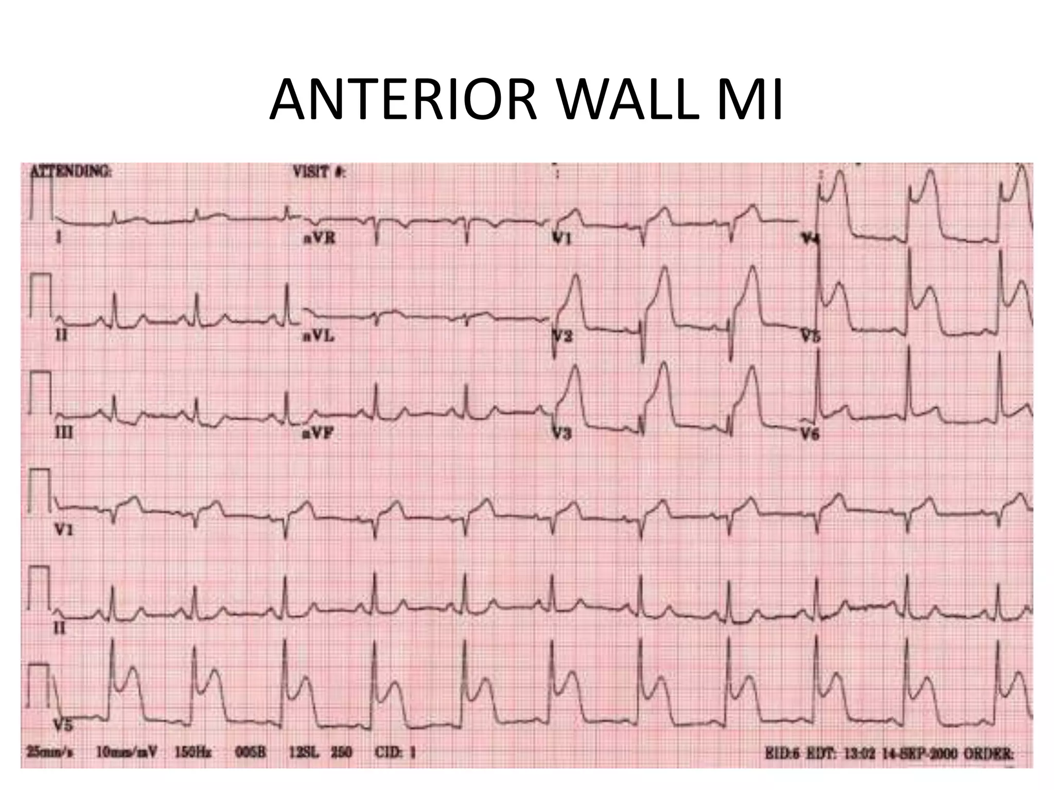 ANTERIOR WALL MI