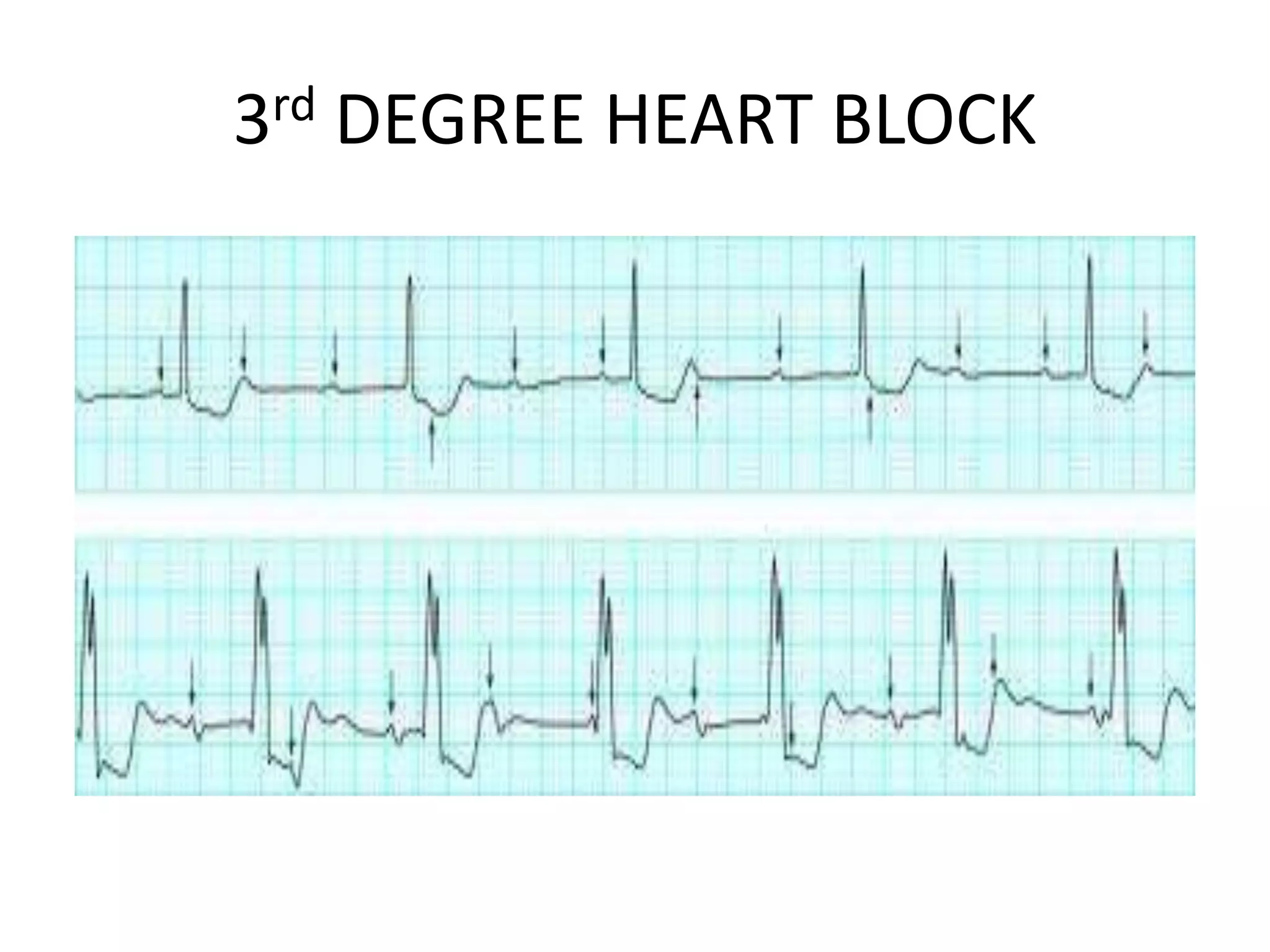 3rd DEGREE HEART BLOCK