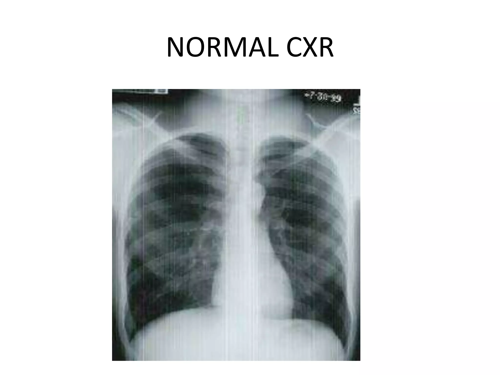 NORMAL CXR
