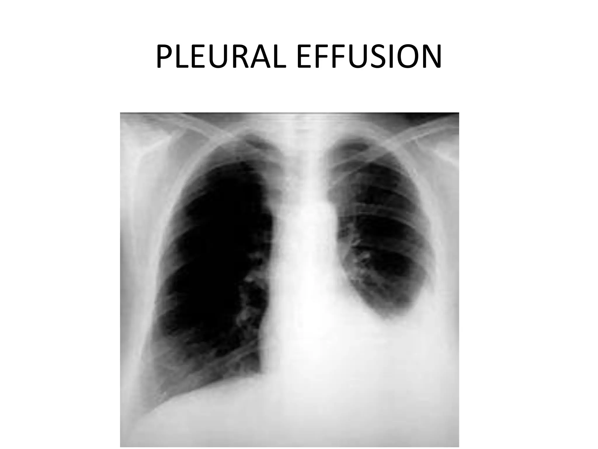 PLEURAL EFFUSION