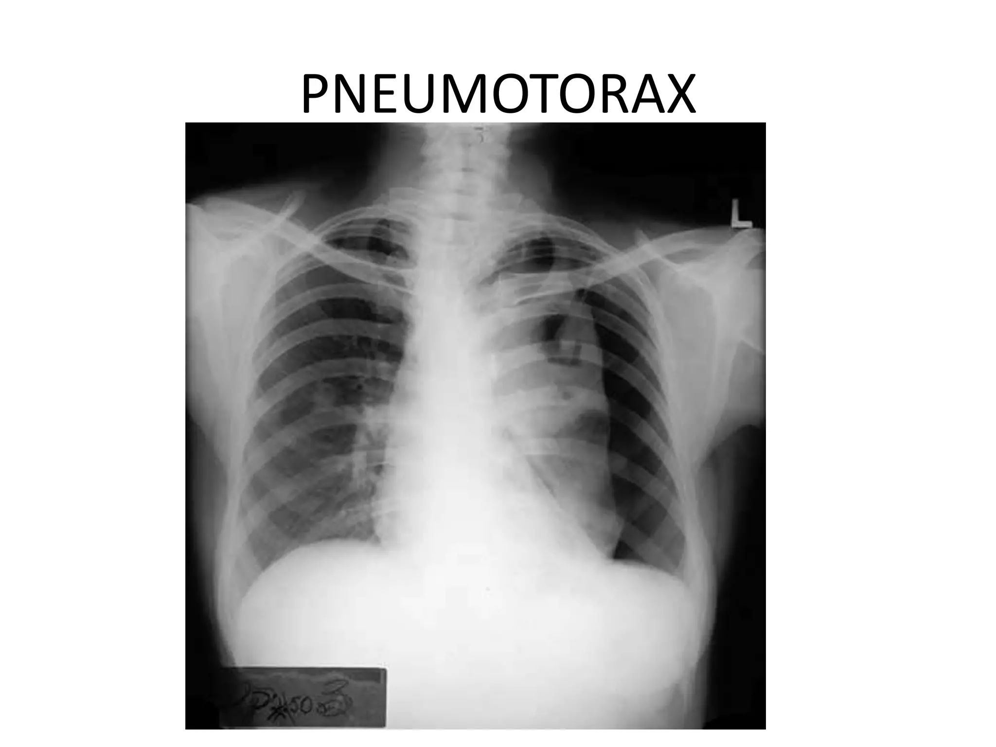 PNEUMOTORAX