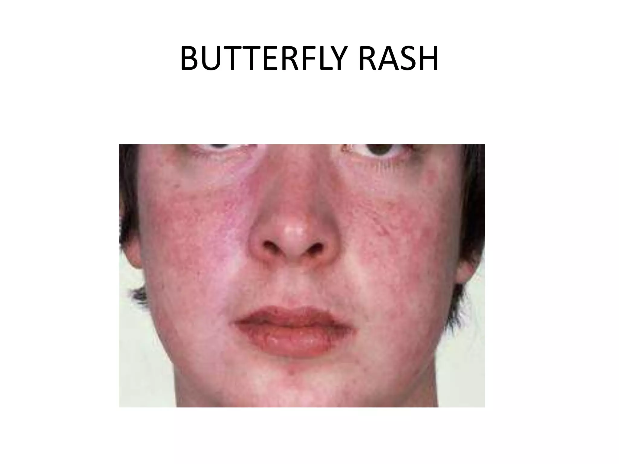 BUTTERFLY RASH
