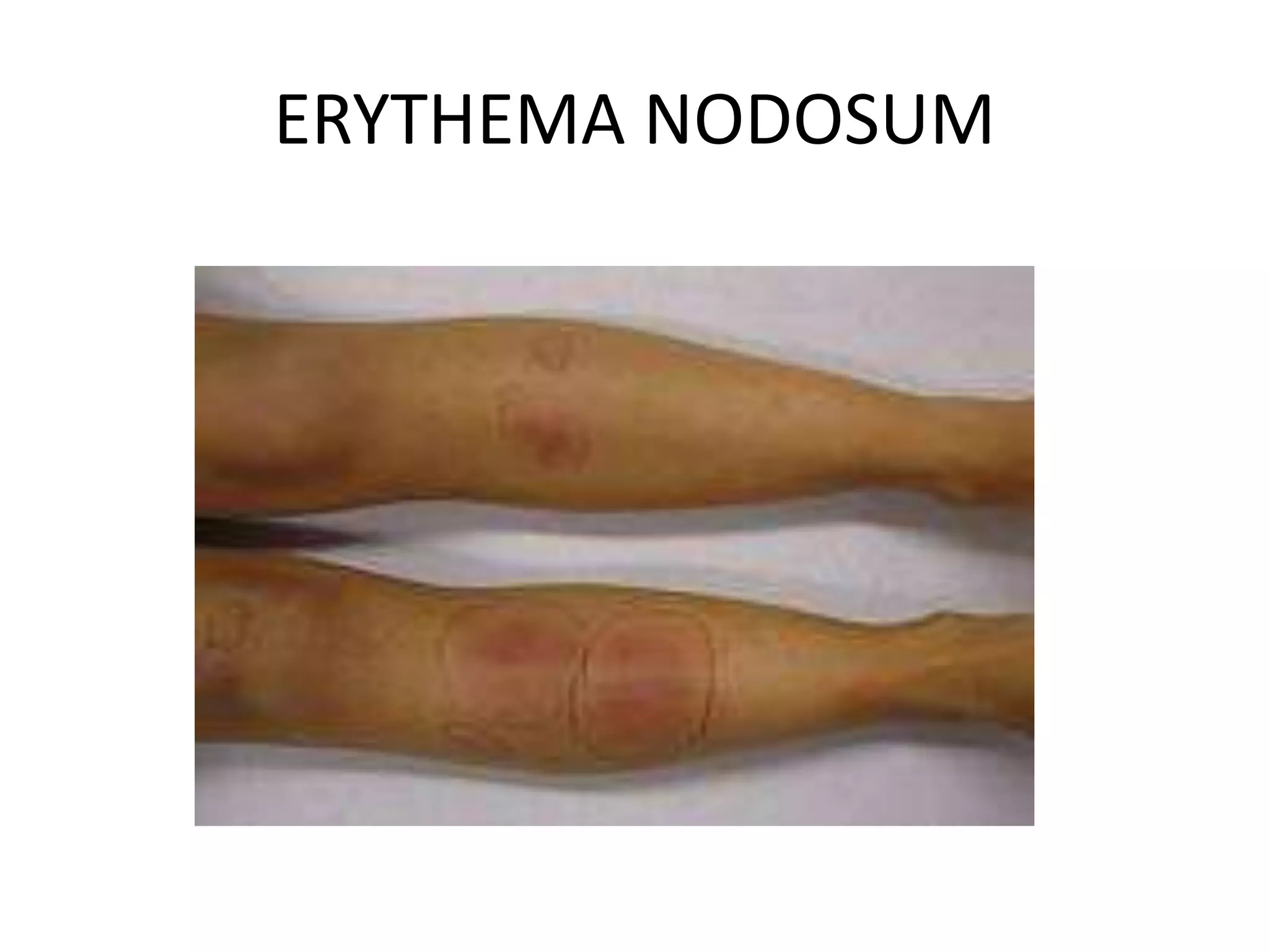 ERYTHEMA NODOSUM