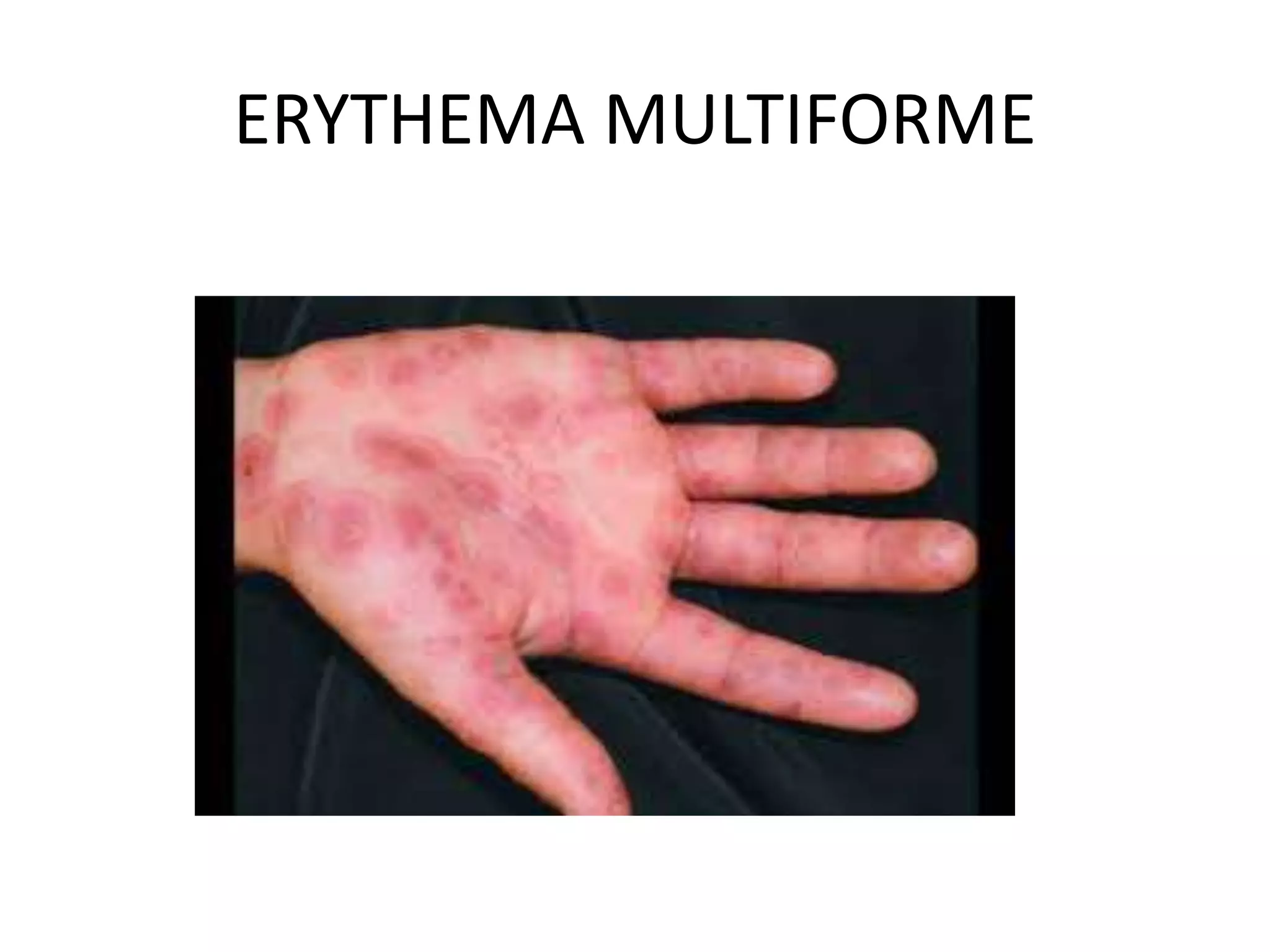 ERYTHEMA MULTIFORME