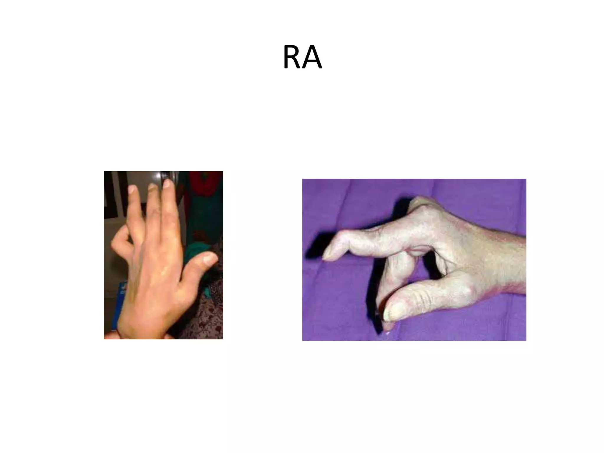 RA