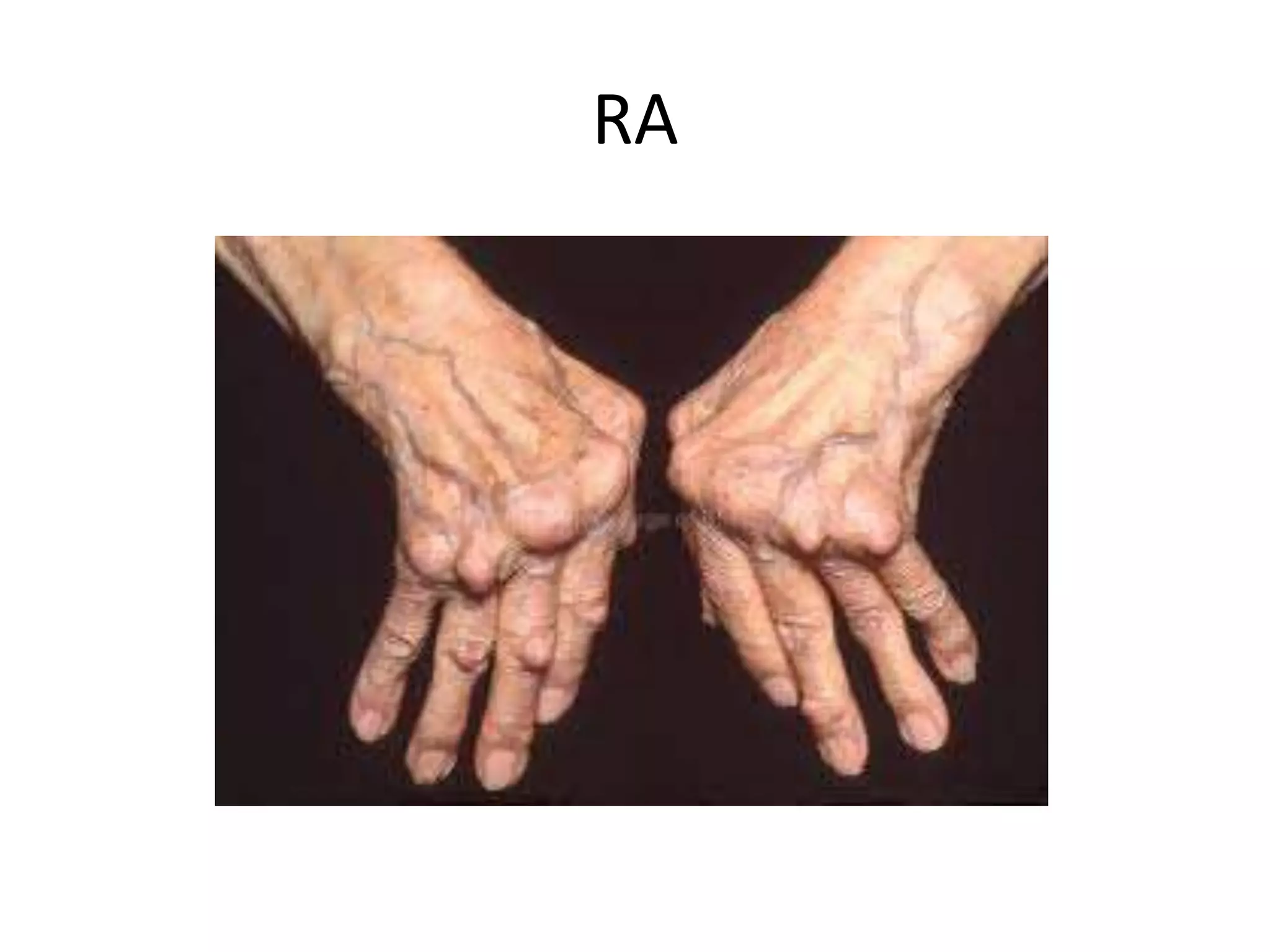 RA