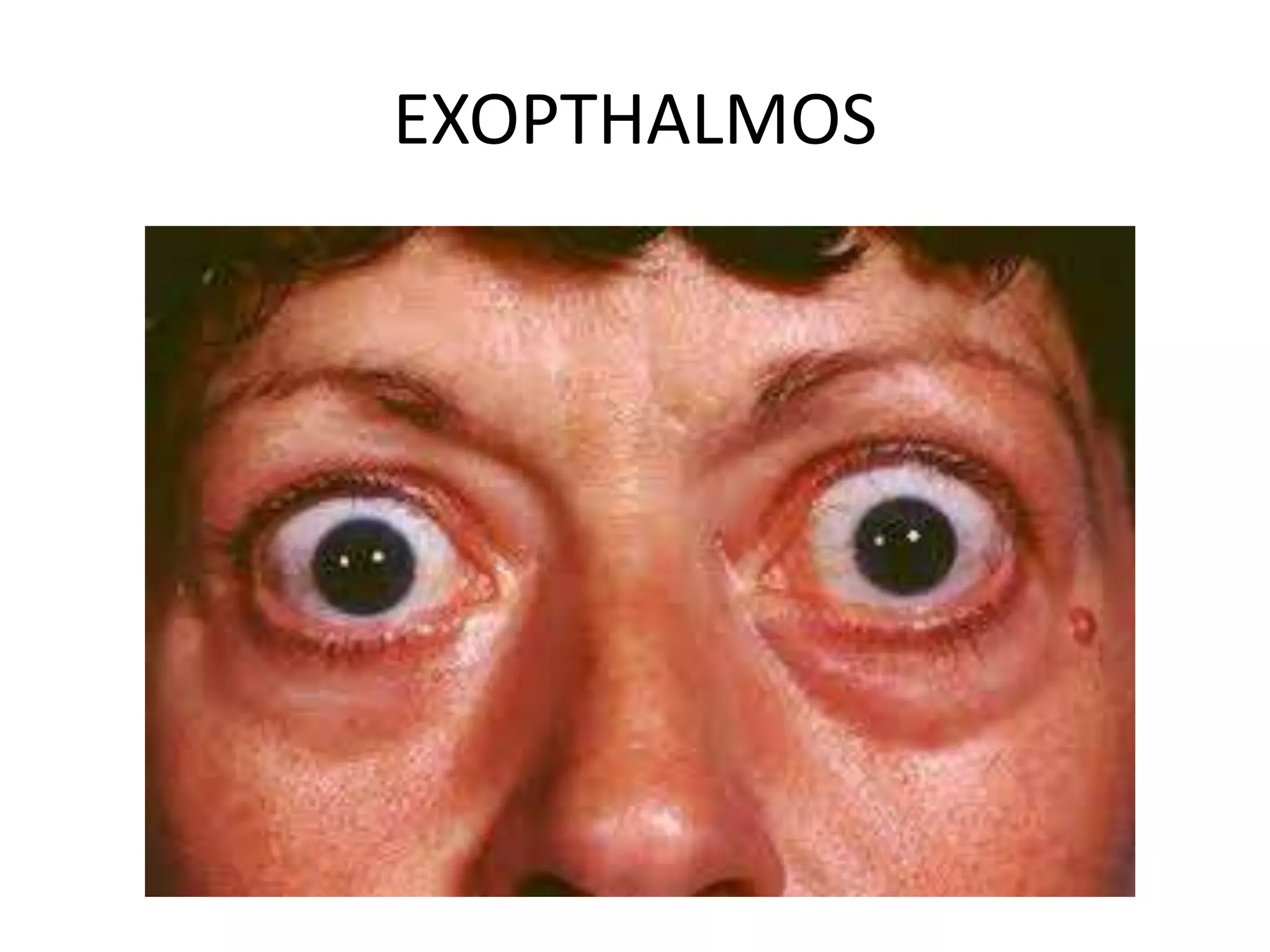 EXOPTHALMOS