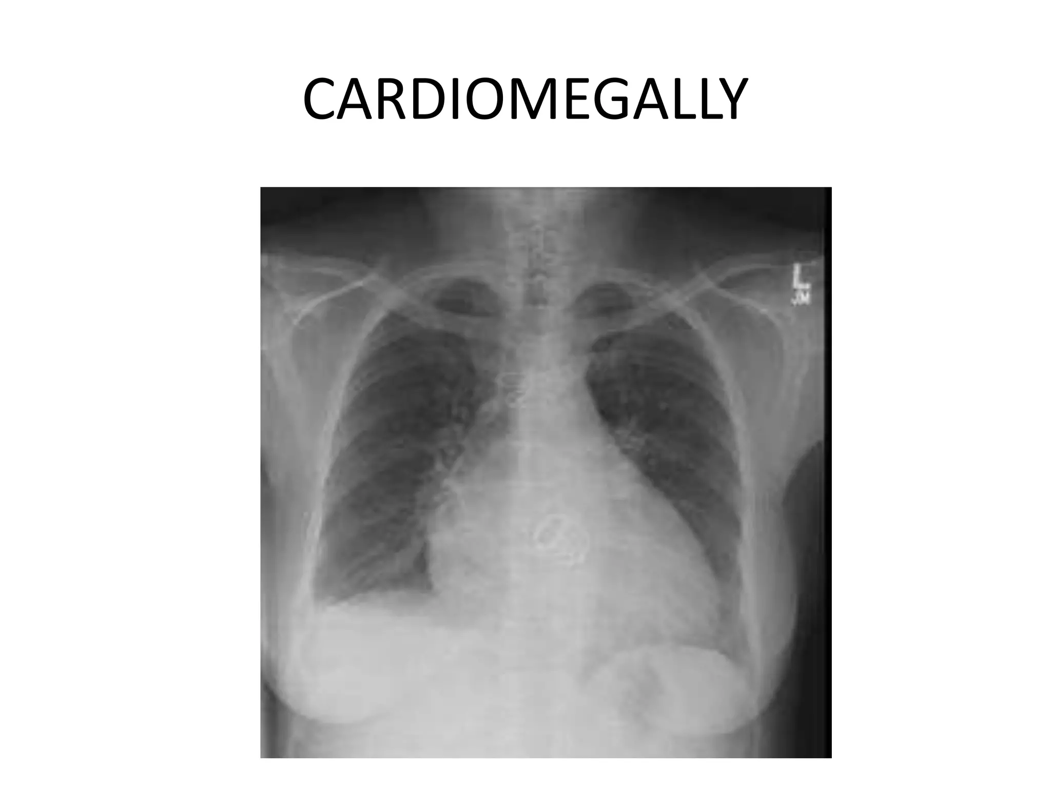 CARDIOMEGALLY