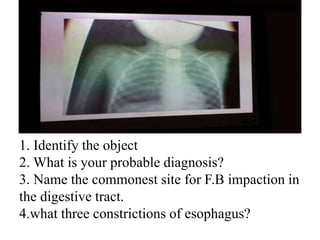 1. Identify the object
2. What is your probable diagnosis?
3. Name the commonest site for F.B impaction in
the digestive tract.
4.what three constrictions of esophagus?
 