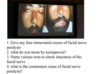 1. Give any four intracranial causes of facial nerve
paralysis
2. What do you mean by neuraprexia?
3. Name various tests to check intactness of the
facial nerve
4. What is the commonest cause of facial nerve
paralysis?
 