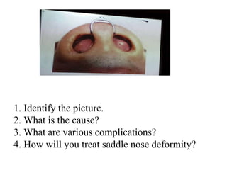 1. Identify the picture.
2. What is the cause?
3. What are various complications?
4. How will you treat saddle nose deformity?
 