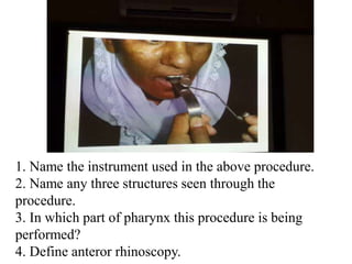 1. Name the instrument used in the above procedure.
2. Name any three structures seen through the
procedure.
3. In which part of pharynx this procedure is being
performed?
4. Define anteror rhinoscopy.
 