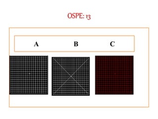 OSPE: 13
A B C
 