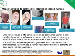 Biologia, 3° ano
Os princípios das Leis da Genética ou Mendelianas
Alguns exemplos de herança autossômica na espécie humana.
Albinismo (falta
de melanina ,
característica
recessiva).
Lobo da orelha
solto ou livre
(DOMINANTE) Capacidade
de enrolar a língua
U (DOMINANTE)
Lobo da orelha
preso ou aderido
(RECESSIVO)
Covinha no queixo
(DOMINANTE)
polidactilia
Herança dominante.
FIM
Uma característica é dita como autossômica dominante quando o gene
está localizado em um dos cromossomos autossômicos e se expressar
fenotipicamente tanto em homozigose (AA)como em heterozigose(Aa).
acondroplasia
Herança dominante.
E autossômica recessiva quando o gene está localizado em um dos
cromossomos autossômicos e se manifesta fenotipicamente somente em
dose dupla (homozigose),(aa).
Imagens da esquerda para direita: (a) Muntuwandi at en.wikipedia / GNU Free Documentation License, (b)
Earpiercing / Public Domain, (c) Siekierkotka / Public Domain, (d) Mckinley.jpg / Public Domain, (e) Todd Dailey
from Santa Clara, CA, United States / Creative Commons Atribuição-Partilha nos Termos da Mesma Licença 2.0
Genérica, (f) Baujat G, Le Merrer M. / Orphanet Journal of Rare Diseases. 2007; 2: 27 / Creative Commons
Attribution 2.0 Generic e (g) Kyle Pacek / GNU Free Documentation License.
 