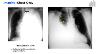 Imaging -Chest X-ray
 