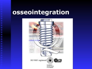 osseointegration 