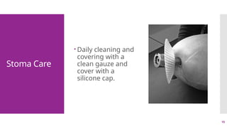 15
Stoma Care
 Daily cleaning and
covering with a
clean gauze and
cover with a
silicone cap.
 