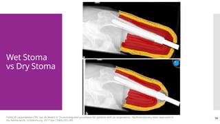 16
Wet Stoma
vs Dry Stoma
Frölke JP, Leijendekkers RA, van de Meent H. Osseointegrated prosthesis for patients with an amputation : Multidisciplinary team approach in
the Netherlands. Unfallchirurg. 2017 Apr;120(4):293-299.
 
