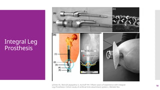 18
Integral Leg
Prosthesis
juhnke DL, Beck JP, Jeyapalina S, Aschoff HH. Fifteen years of experience with Integral-
Leg-Prosthesis: Cohort study of artificial limb attachment system. J Rehabil Res
 
