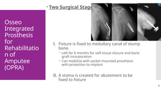 8
Osseo
Integrated
Prosthesis
for
Rehabilitatio
n of
Amputee
(OPRA)
 Two Surgical Stages
I. Fixture is fixed to medullary canal of stump
bone.
 Left for 6 months for soft tissue closure and bone
graft incorporation
 Can mobilize with socket mounted prosthesis
with protection to implant
II. A stoma is created for abutement to be
fixed to fixture
 