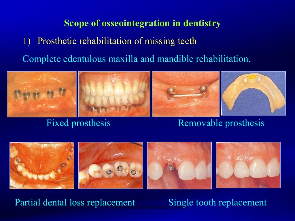 Osseointegration/ orthodontic continuing education
