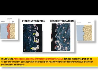 In 1986,the American Academy of Implant Dentistry(AAID) defined Fibrointegration as
“Tissue to implant contact with interposition healthy dense collagenous tissue between
the implant and bone’’
 