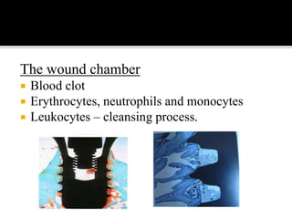 The wound chamber
 Blood clot
 Erythrocytes, neutrophils and monocytes
 Leukocytes – cleansing process.
 