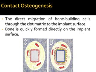 • The direct migration of bone-building cells
through the clot matrix to the implant surface.
• Bone is quickly formed directly on the implant
surface.
 