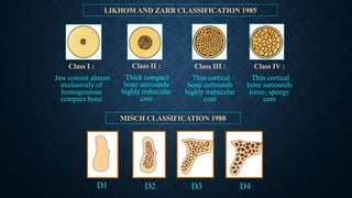 LIKHOM AND ZARB CLASSIFICATION 1985
Class I :
Jaw consist almost
exclusively of
homogeneous
compact bone
Class II :
Thick compact
bone surrounds
highly trabecular
core
Class III :
Thin cortical
bone surrounds
highly trabecular
core
Class IV :
Thin cortical
bone surrounds
loose, spongy
core
D1 D2 D3 D4
MISCH CLASSIFICATION 1988
 