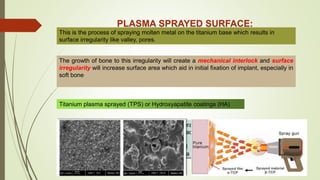 PLASMA SPRAYED SURFACE:
This is the process of spraying molten metal on the titanium base which results in
surface irregularity like valley, pores.
The growth of bone to this irregularity will create a mechanical interlock and surface
irregularity will increase surface area which aid in initial fixation of implant, especially in
soft bone
Titanium plasma sprayed (TPS) or Hydroxyapatite coatings (HA)
Hydroxyapatite bonds well with bone and accelerates new bone formation in initial
healing period with formation of osteophylic surface.
In order to increase bone formation in initial stages in cases like immediate implant
placement and poor bone quality, HA surface is a good choice.
 